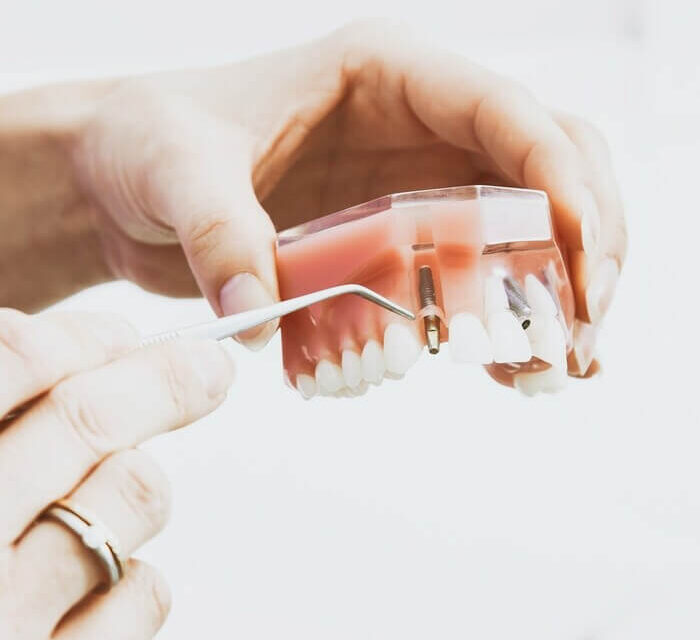 Ghid complet despre implanturile dentare